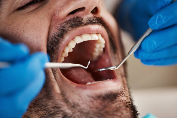 Best Emergency Wisdom Tooth Extraction in Bluffton, OH
