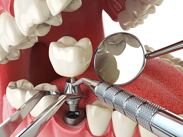 Best Emergency Care for Gum Disease in Bluffton, OH