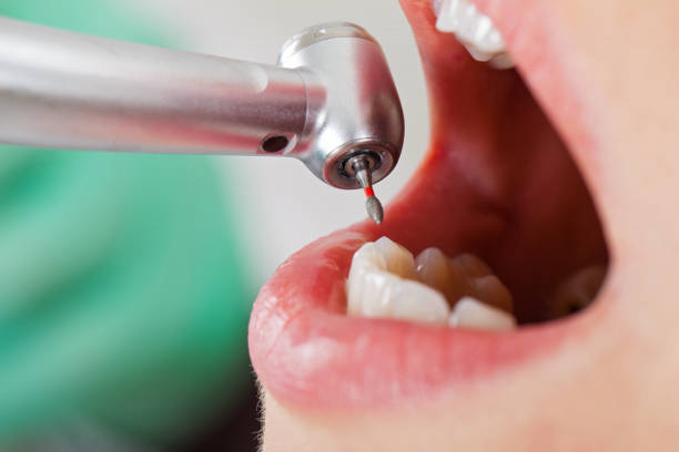 Best Broken or Chipped Tooth Repair in Bluffton, OH